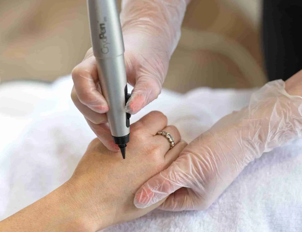 Is Cryosonic Safe for All Skin Types Exeter