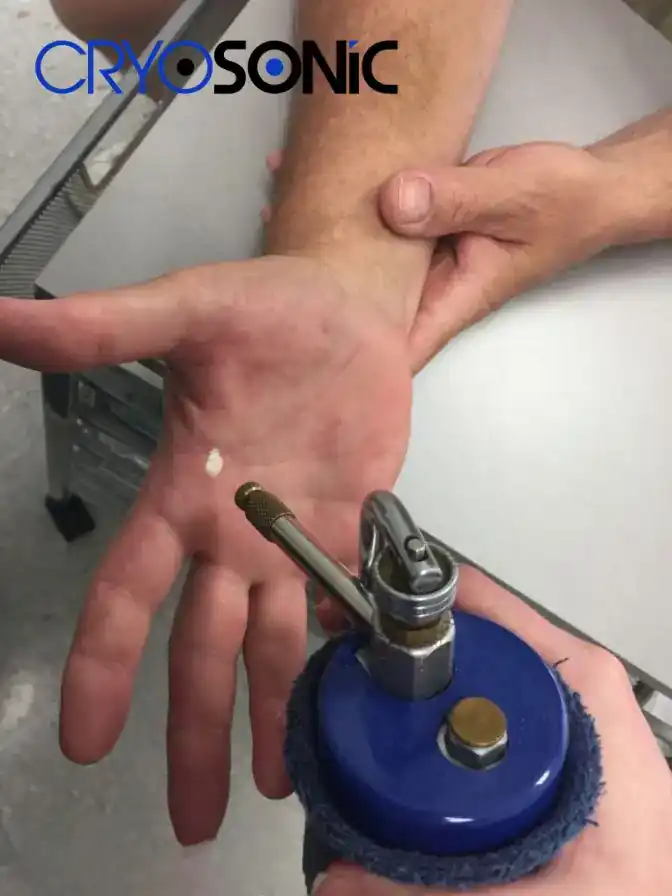 Temperature Differences: OTC vs Medical-Grade Cryotherapy Exeter